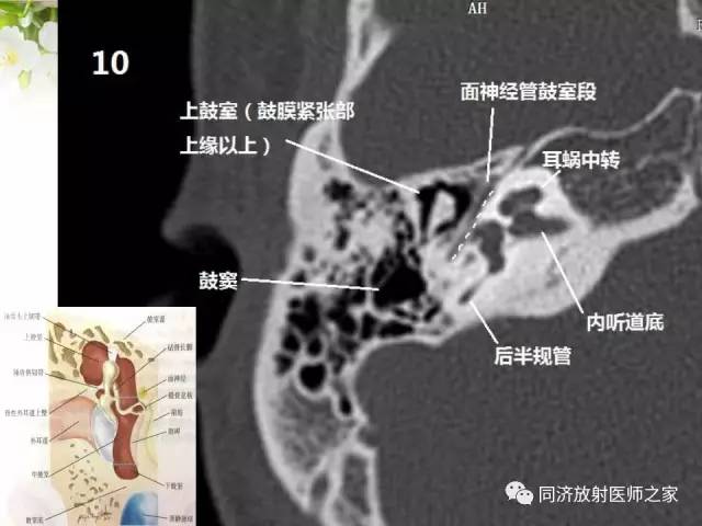 【PPT】耳部CT影像解剖及常见病的认识