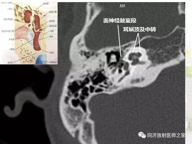 【PPT】耳部CT影像解剖及常见病的认识
