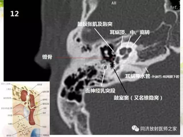 【PPT】耳部CT影像解剖及常见病的认识