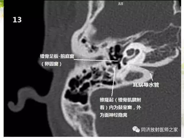 【PPT】耳部CT影像解剖及常见病的认识