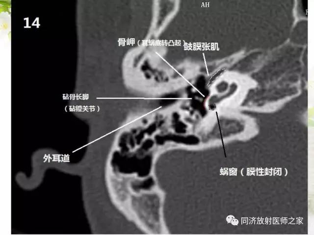 【PPT】耳部CT影像解剖及常见病的认识