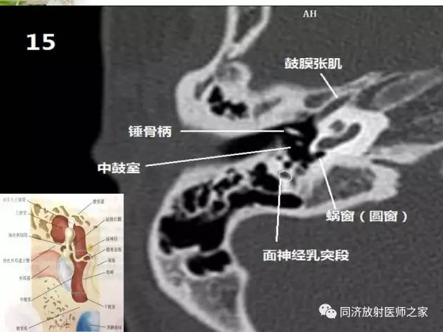 【PPT】耳部CT影像解剖及常见病的认识