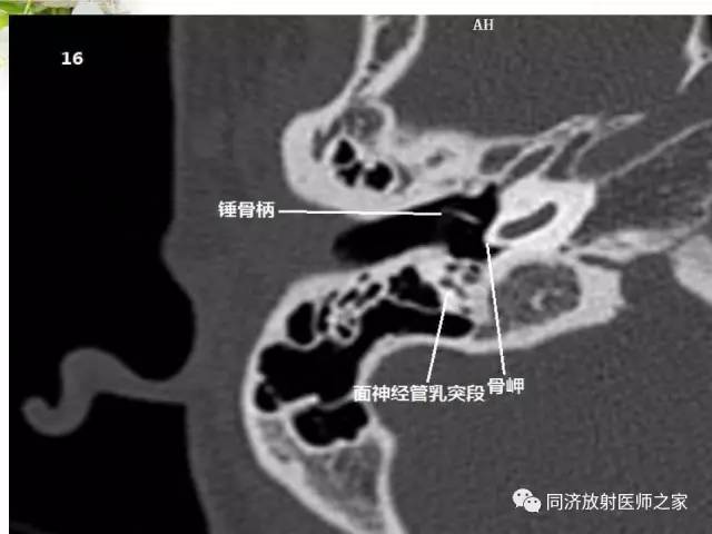 【PPT】耳部CT影像解剖及常见病的认识