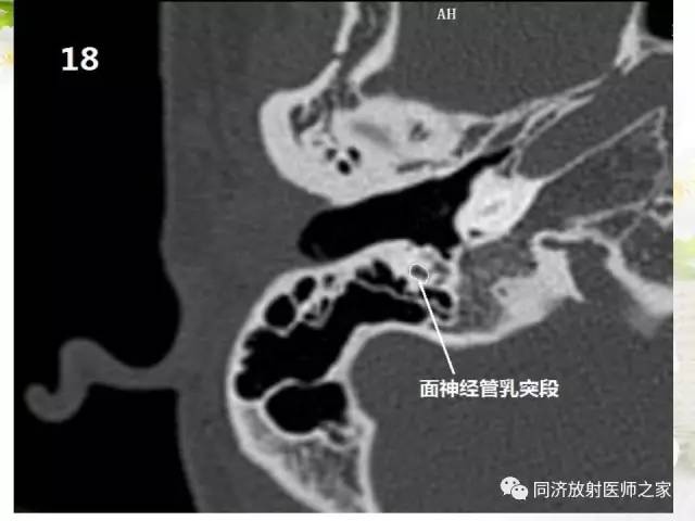 【PPT】耳部CT影像解剖及常见病的认识