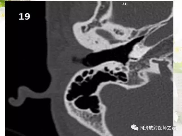【PPT】耳部CT影像解剖及常见病的认识