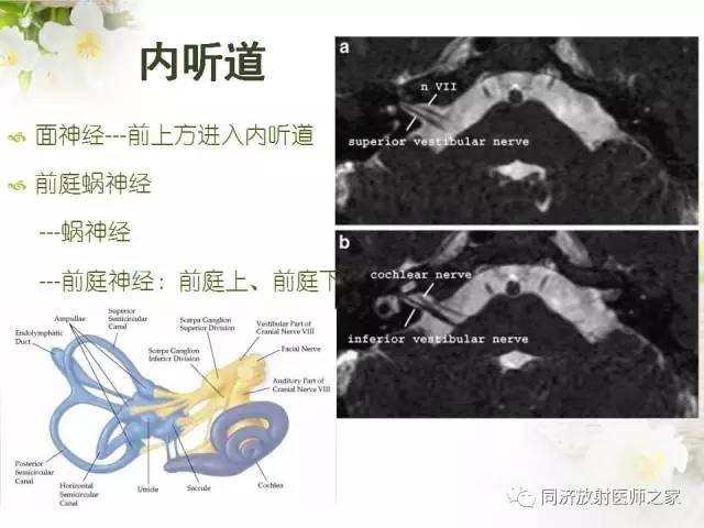 【PPT】耳部CT影像解剖及常见病的认识