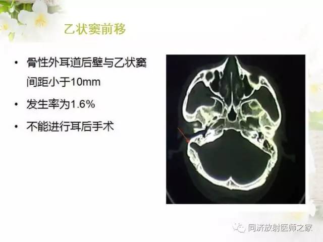 【PPT】耳部CT影像解剖及常见病的认识