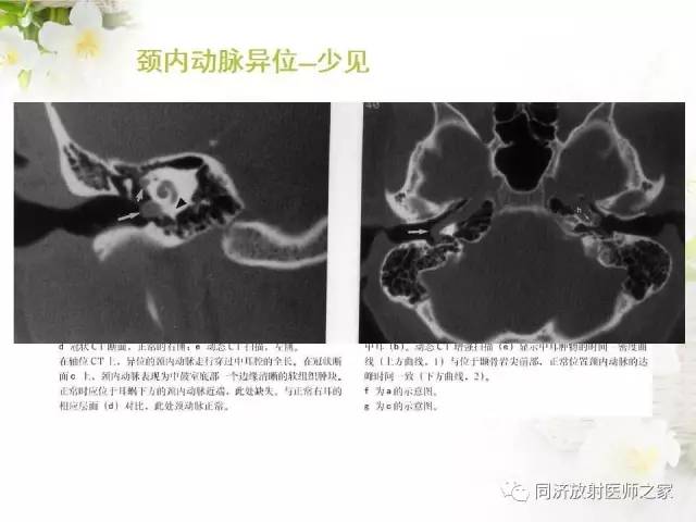 【PPT】耳部CT影像解剖及常见病的认识