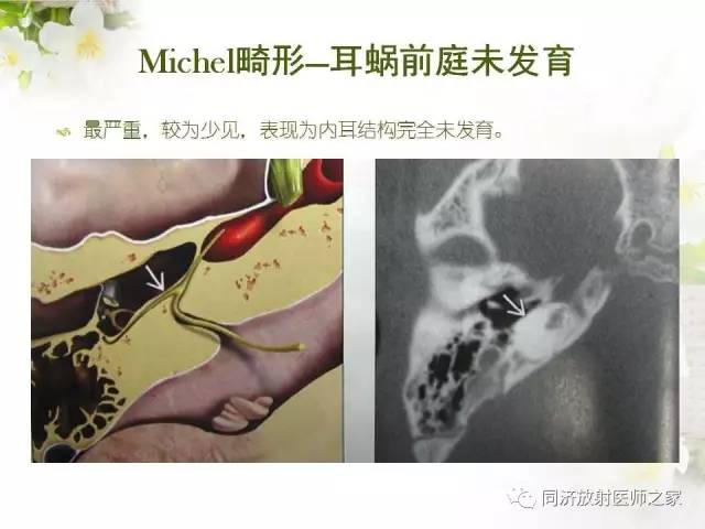 【PPT】耳部CT影像解剖及常见病的认识