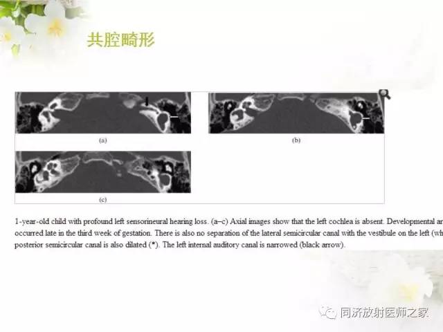 【PPT】耳部CT影像解剖及常见病的认识