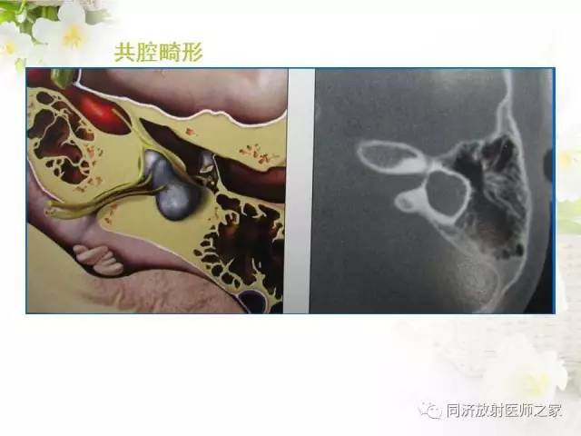 【PPT】耳部CT影像解剖及常见病的认识