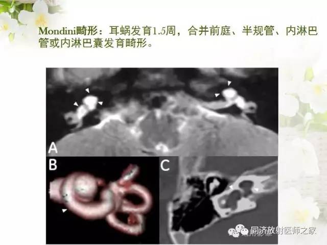 【PPT】耳部CT影像解剖及常见病的认识