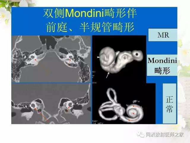 【PPT】耳部CT影像解剖及常见病的认识