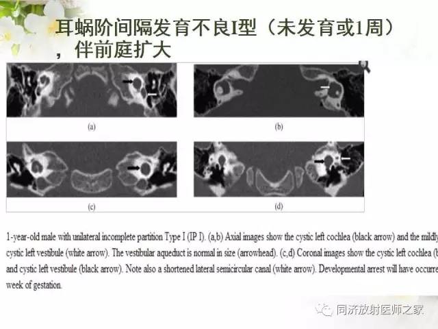 【PPT】耳部CT影像解剖及常见病的认识
