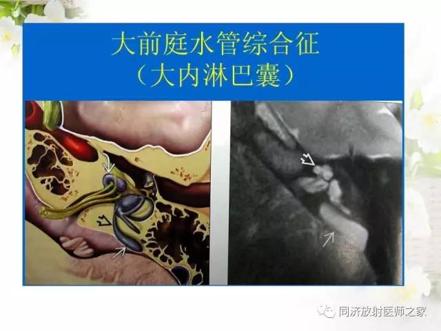 【PPT】耳部CT影像解剖及常见病的认识