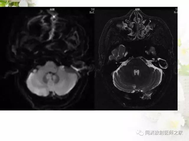 【PPT】耳部CT影像解剖及常见病的认识