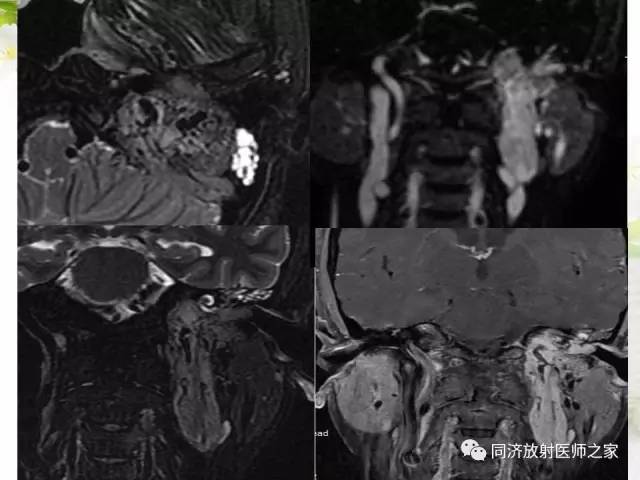 【PPT】耳部CT影像解剖及常见病的认识
