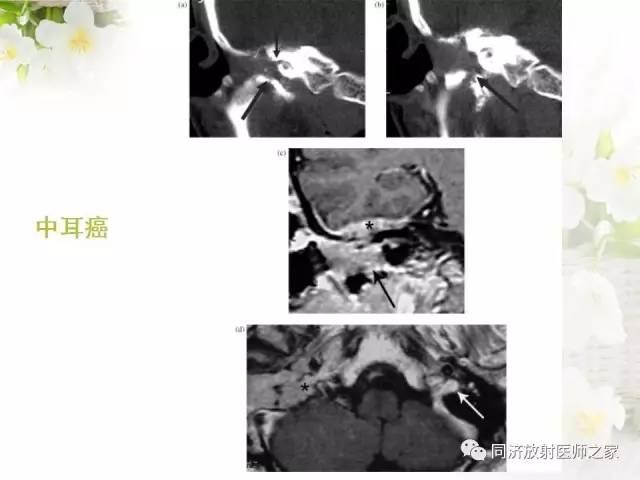 【PPT】耳部CT影像解剖及常见病的认识