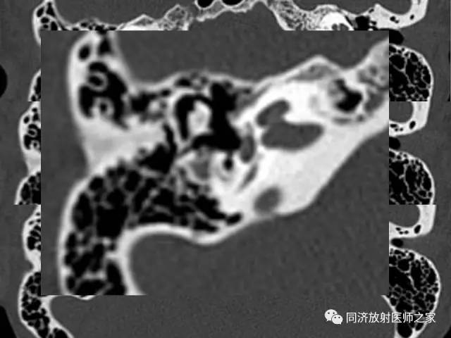 【PPT】耳部CT影像解剖及常见病的认识