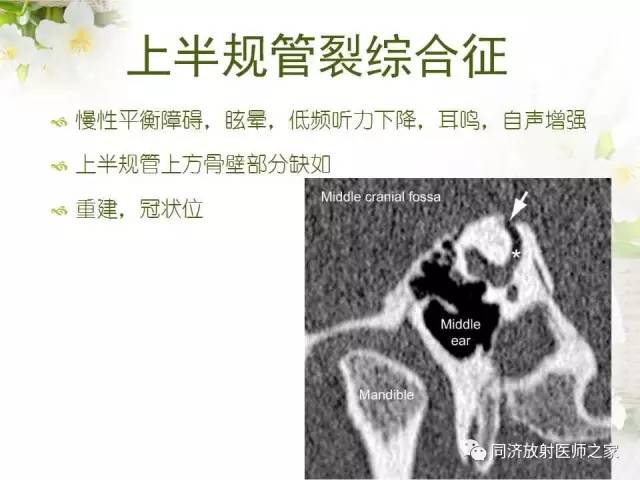 【PPT】耳部CT影像解剖及常见病的认识