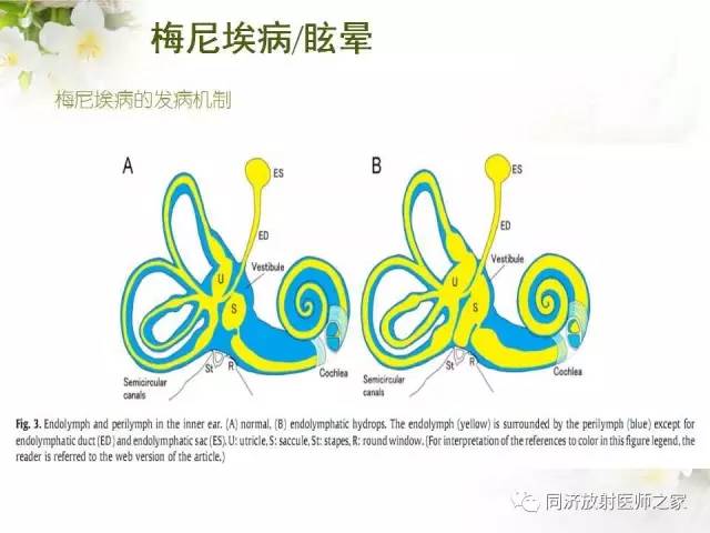 【PPT】耳部CT影像解剖及常见病的认识