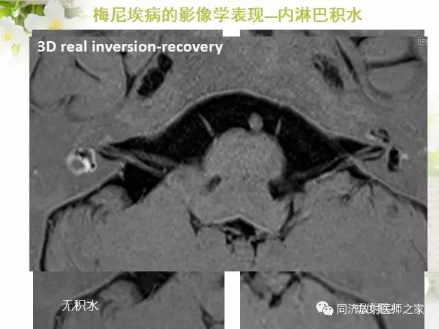 【PPT】耳部CT影像解剖及常见病的认识