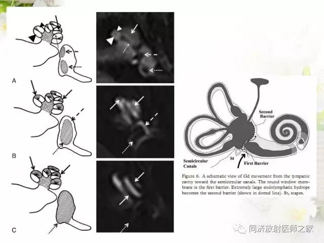 【PPT】耳部CT影像解剖及常见病的认识