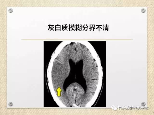 【PPT】超急性期脑梗塞的CT诊断