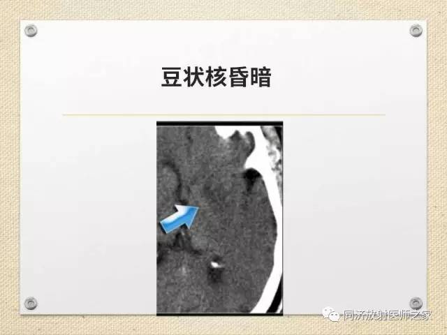 【PPT】超急性期脑梗塞的CT诊断