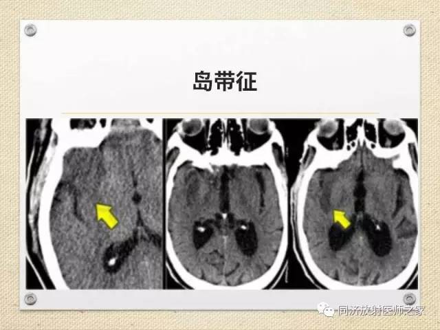 【PPT】超急性期脑梗塞的CT诊断