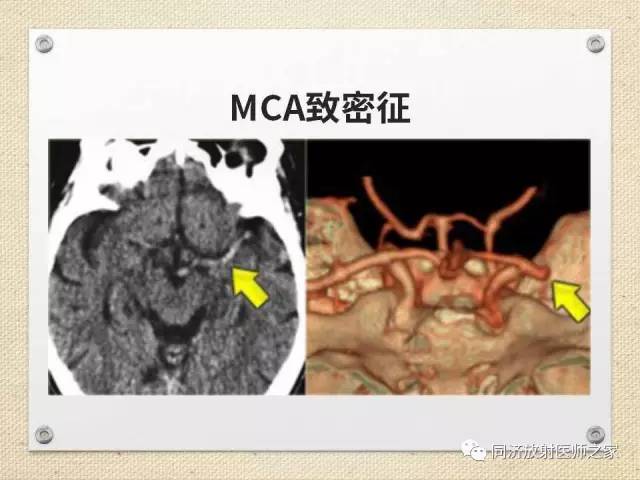 【PPT】超急性期脑梗塞的CT诊断