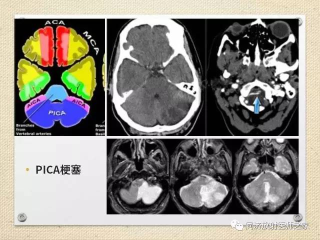 【PPT】超急性期脑梗塞的CT诊断