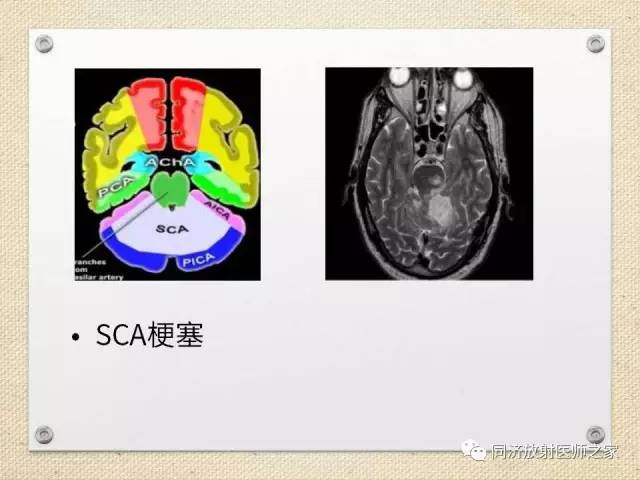 【PPT】超急性期脑梗塞的CT诊断