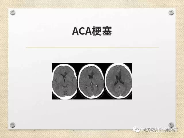 【PPT】超急性期脑梗塞的CT诊断