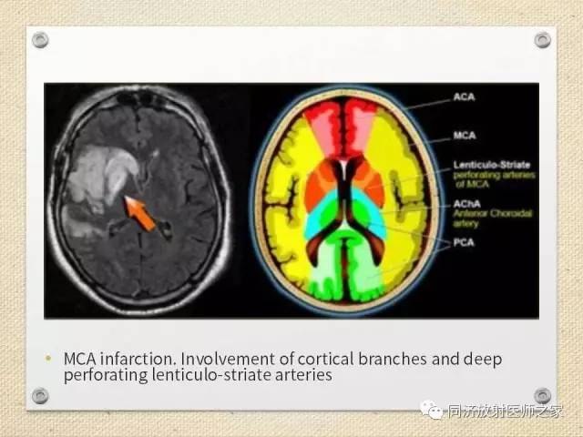 【PPT】超急性期脑梗塞的CT诊断