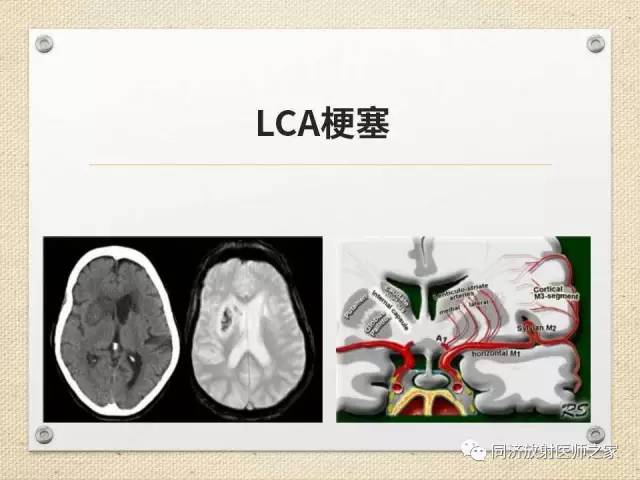 【PPT】超急性期脑梗塞的CT诊断