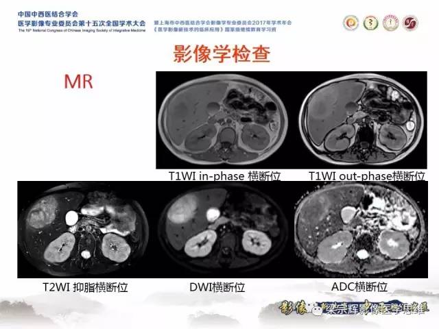 【病例】肝糖原累积症伴肝腺瘤1例MR