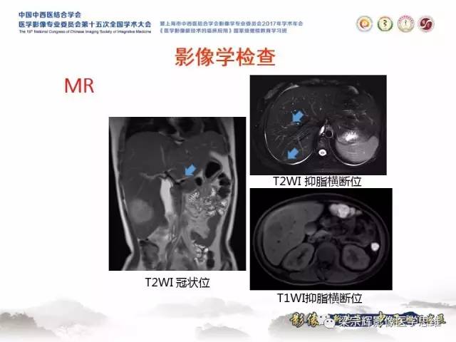 【病例】肝糖原累积症伴肝腺瘤1例MR