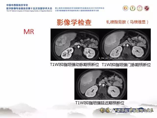 【病例】肝糖原累积症伴肝腺瘤1例MR