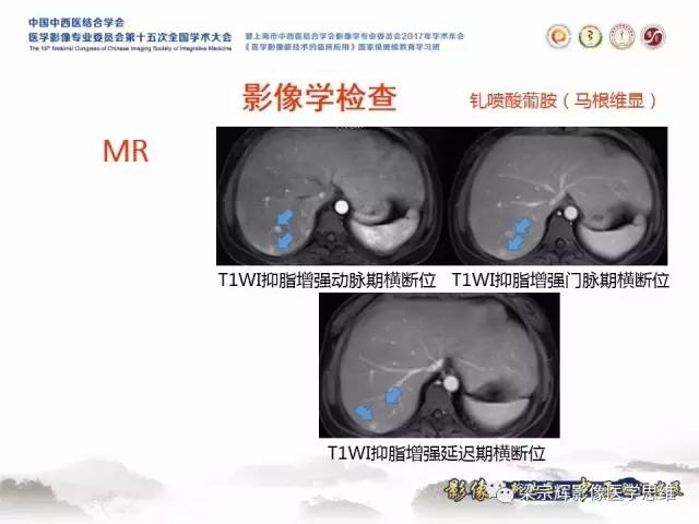 【病例】肝糖原累积症伴肝腺瘤1例MR