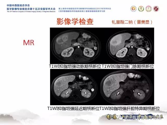 【病例】肝糖原累积症伴肝腺瘤1例MR