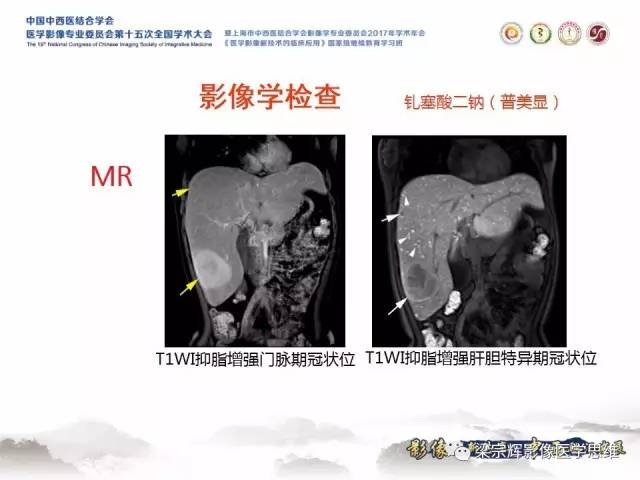 【病例】肝糖原累积症伴肝腺瘤1例MR