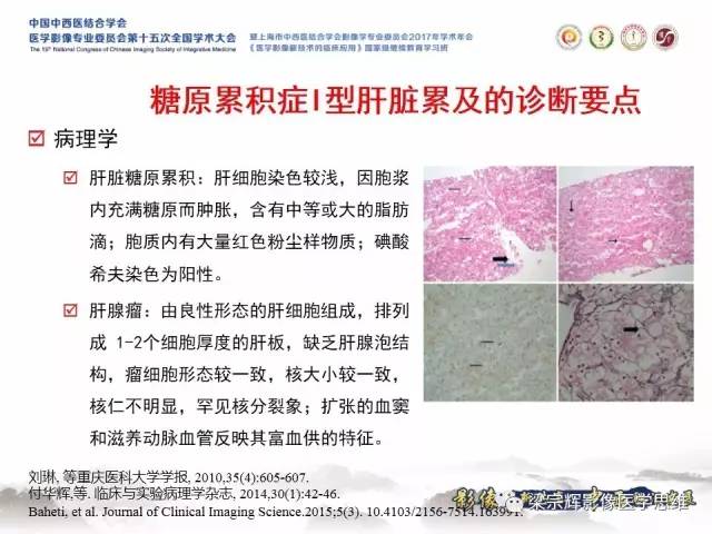 【病例】肝糖原累积症伴肝腺瘤1例MR