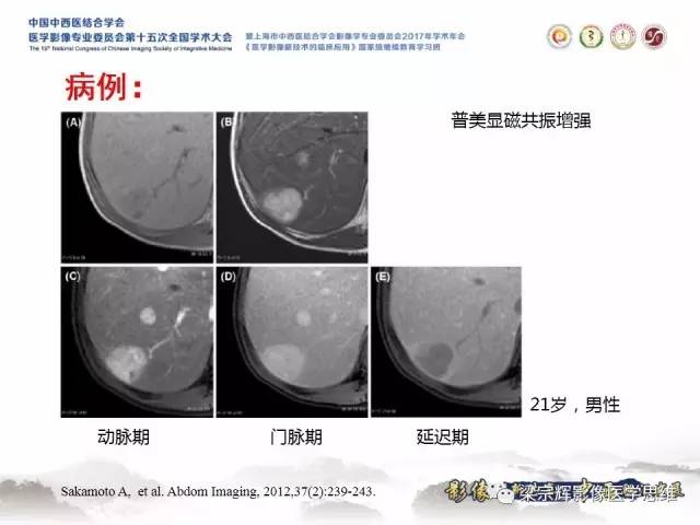 【病例】肝糖原累积症伴肝腺瘤1例MR