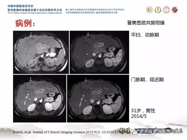 【病例】肝糖原累积症伴肝腺瘤1例MR