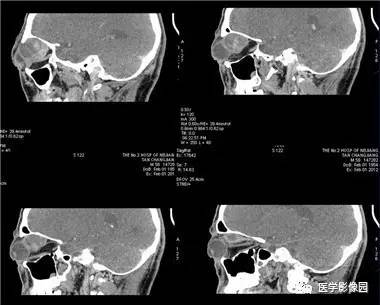 【病例】眼眶腺样囊性癌1例CT影像表现 【病例】眼眶腺样囊性癌1例CT影像表现