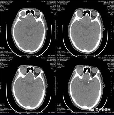 【病例】眼眶腺样囊性癌1例CT影像表现 【病例】眼眶腺样囊性癌1例CT影像表现