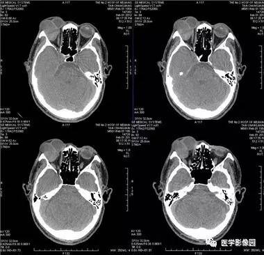 【病例】眼眶腺样囊性癌1例CT影像表现 【病例】眼眶腺样囊性癌1例CT影像表现