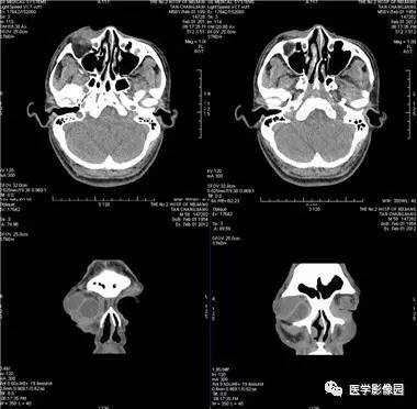 【病例】眼眶腺样囊性癌1例CT影像表现 【病例】眼眶腺样囊性癌1例CT影像表现
