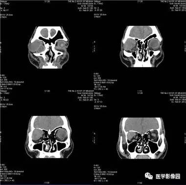 【病例】眼眶腺样囊性癌1例CT影像表现 【病例】眼眶腺样囊性癌1例CT影像表现